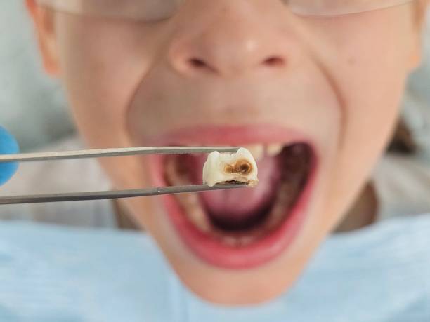 Best Emergency Treatment for Dental Infections or Abscesses in Williamsburg, KY